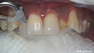 Teeth Polishing