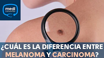 ¿Como es un melanoma benigno?