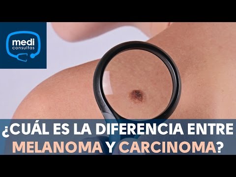 Video: ¿El melanoma lentiginoso acral puede ser benigno?