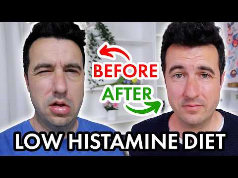 I Tried the Low-Histamine Diet for a Week (Chronic Hives Update)