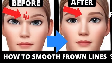 Easy Face Yoga to Erase Frown Lines & Wrinkles Between Eyebrows (No Botox!)