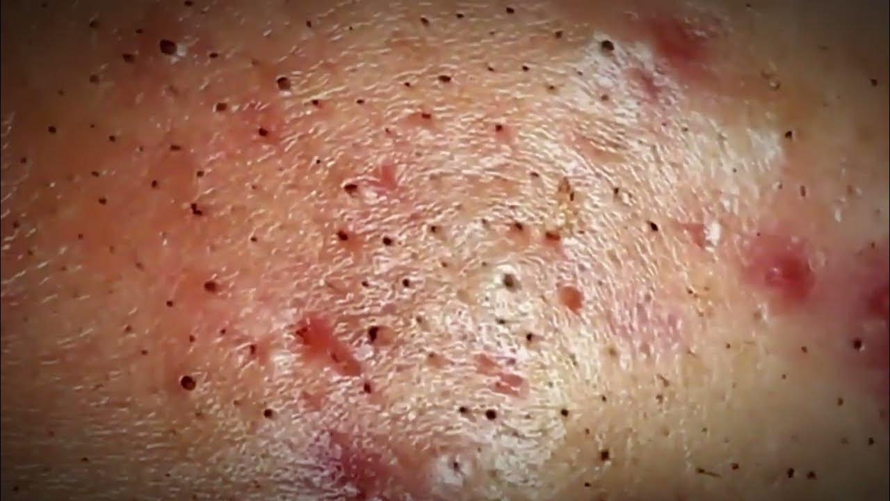 Most Satisfying Blackhead Removal Compilation! WARNING! YouTube