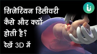 C-section: सिजेरियन डिलीवरी क्यों और कैसे की जाती है, देखें 3D में - Cesarean delivery in Hindi