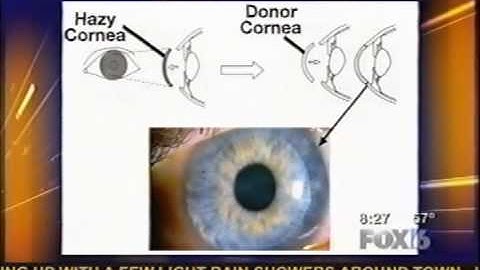 Intacs Implants for Keratoconus | San Diego Ophthalmology