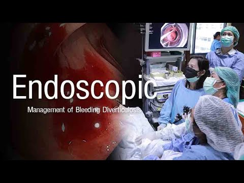 “Endoscopic Management of Bleeding Diverticulosis"