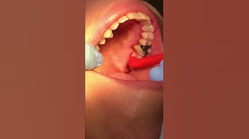 Sub gingival brushing using ISB