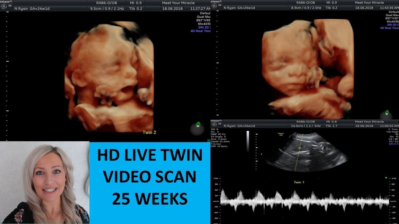 Amazing Live Hd Twin Scan 25 Weeks Pregnant Youtube