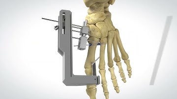 PROstep MIS Lapidus - Surgical Animation
