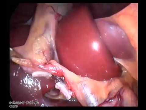 Lap Chole Unedited 20170108 01 Simple Case Good Anatominal View