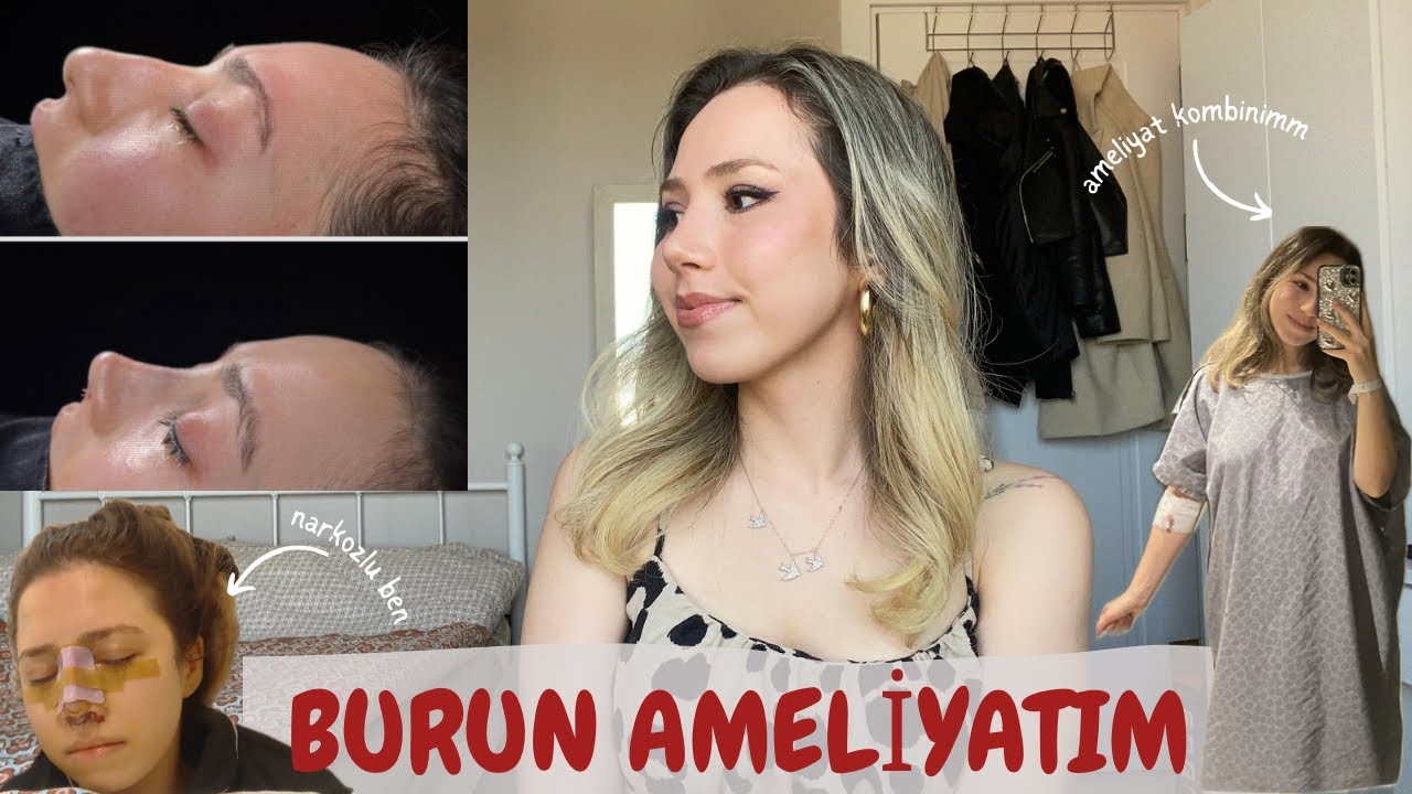 BURUN AMELİYATIM | gün gün süreç, fiyatlar, morluksuz 💕