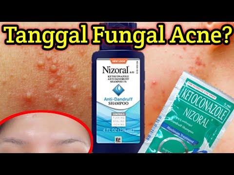 MABISANG PANTANGGAL NG TIGYAWAT SA NOO O FUNGAL ACNE TREAT FUNGAL ACNE WITH NIZORAL SHAMPOO -