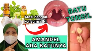 HINDARI TERBENTUKNYA BATU AMANDEL - ATASI DENGAN KONSUMSI MAKANAN MUJARAB INI