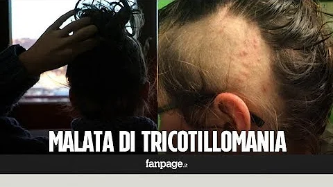 Chi soffre di tricotillomania?