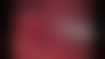 Laparoscopic  Nephrectomy in Xanthogranulomatous Pyelonephritis