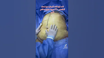 شد ترهلات البطن مع نحت الخصر ٣٦٠ درجه وتقويه عضلات البطن 