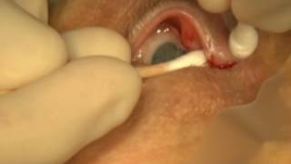 Treatment of Canaliculitis Resimi