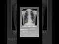 Signs on chest X-ray Finding #radiology #radiologist #medicine #medical #nursing #medicalstudent