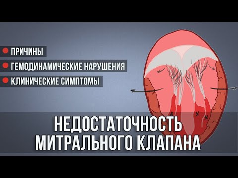 Недостаточность митрального клапана │ Симптомы, гемодинамика, клиника