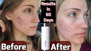 I Tried Curology for 60 Days *NOT SPONSORED (With Before & After Pictures)