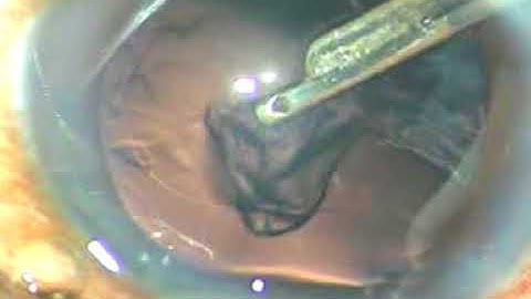 Lens Tilt Technique (LTT) for managing soft cataracts - P Mohanta, 9/1/18, NEH