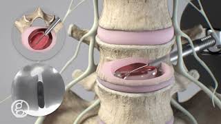 OptiLIF® Endo System - Spineology - 4K Animation