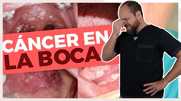 ¿Son cancerosas las manchas blancas en la lengua?