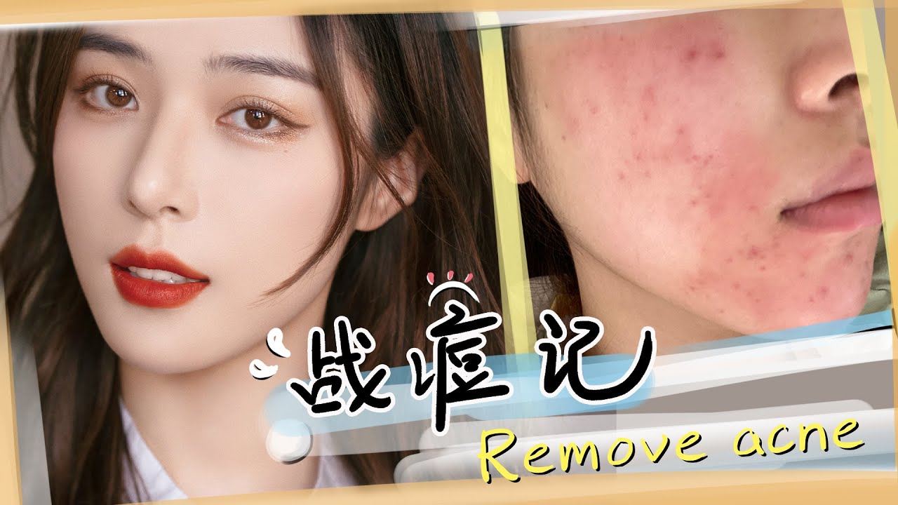 【战痘记】长痘烂脸真是搞我心态！为了战痘拼了！Acne Treatment  [仇仇-qiuqiu]
