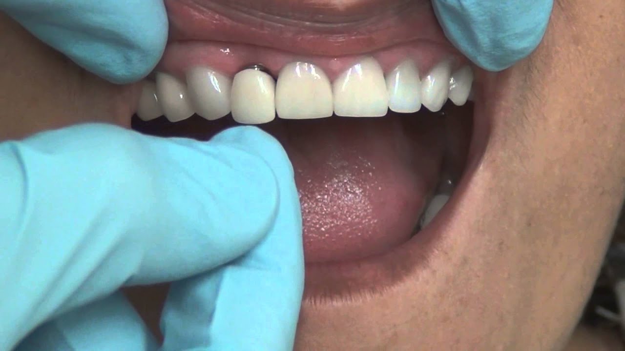 How to Darken Dental Crowns?