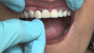 how to make crowns a shade darker