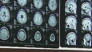 Health Watch | New study shows multiple sclerosis may be present earlier; younger people getting dia