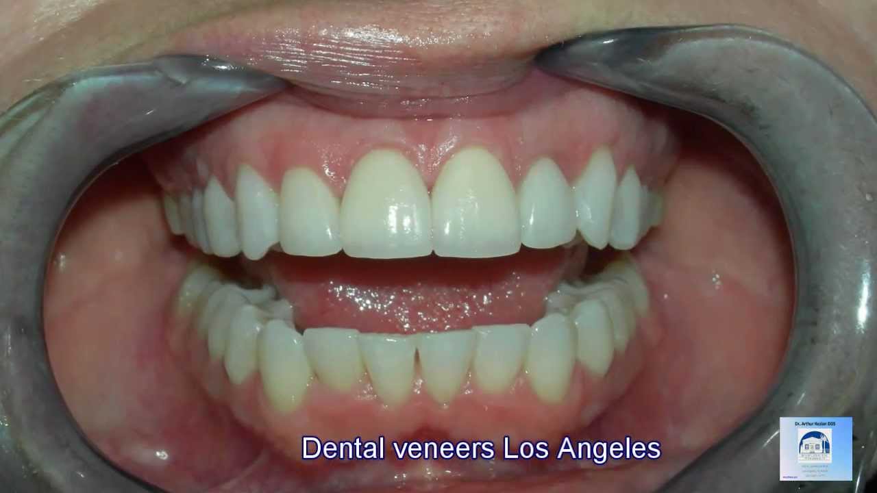 Dental Veneers Los Angeles YouTube