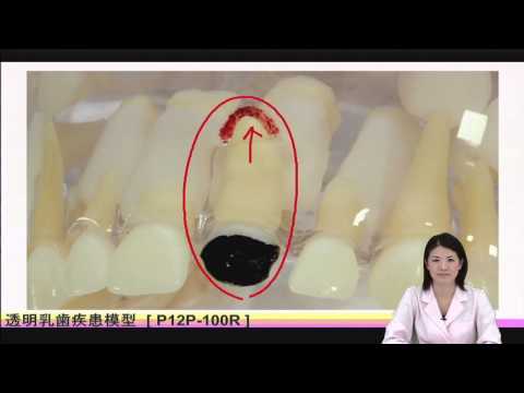 透明乳歯疾患模型 [PE-TDS002] (旧型番：P12P-100R) - YouTube
