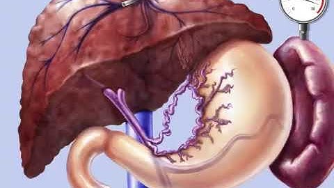 TIPSS, Transjugular Intrahepatic Porto-Systemic Shunt
