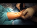 Percutaneous achilles tendon surgery repair unedited by kevin r stone md