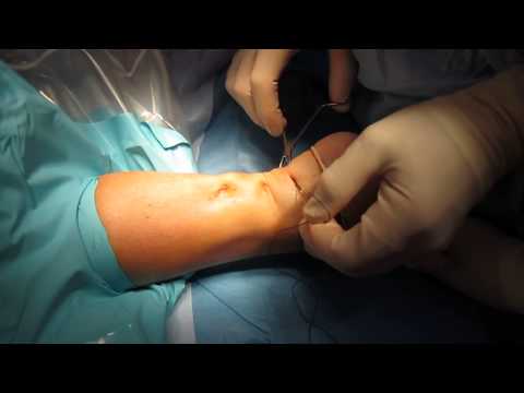 Percutaneous Achilles Tendon Surgery Repair (Unedited) by Kevin R. Stone, MD