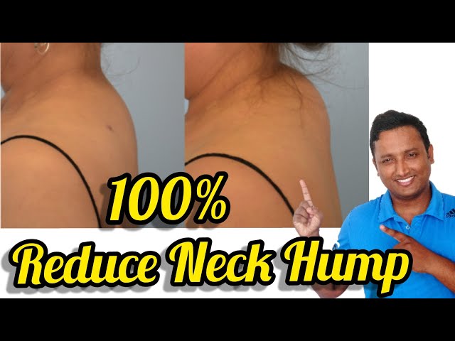 Neck Hump, How to Get Rid of Buffalo Hump, EP 23, Groove With Garima  Bhandari, Fit Tak