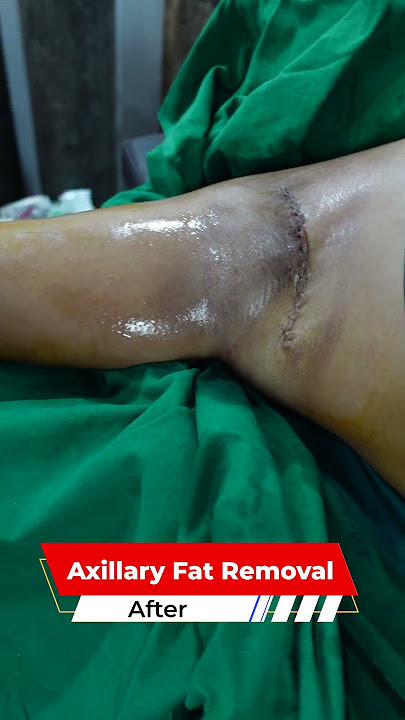 Axillary Fat Removal | Axillary Fat cost | Axillary Fat video | Axillary Fat Surgery
