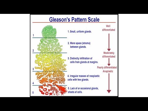 Видео: Понимание рака простаты: шкала Глисона
