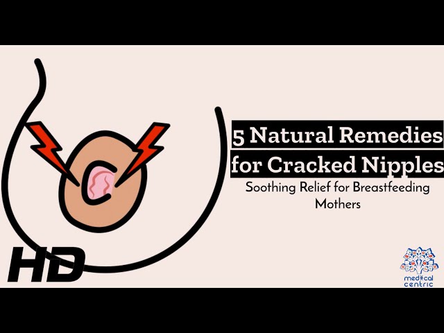 6 Home Remedies For Sore, Cracked Nipples — Milkology®