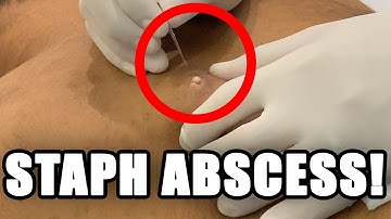 STAPH ABSCESS! 🦠