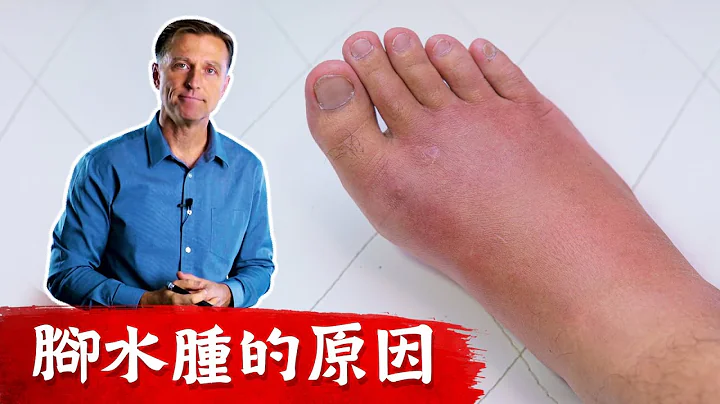 腳水腫的原因,不要掩蓋症狀!!柏格醫生 Dr Berg - 天天要聞
