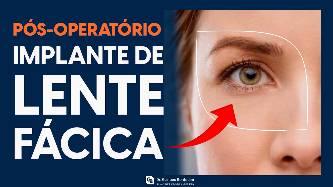 Pós-operatório de implante de lente fácica: tratamento da alta miopia e astigmatismo  - Dr. Gustavo