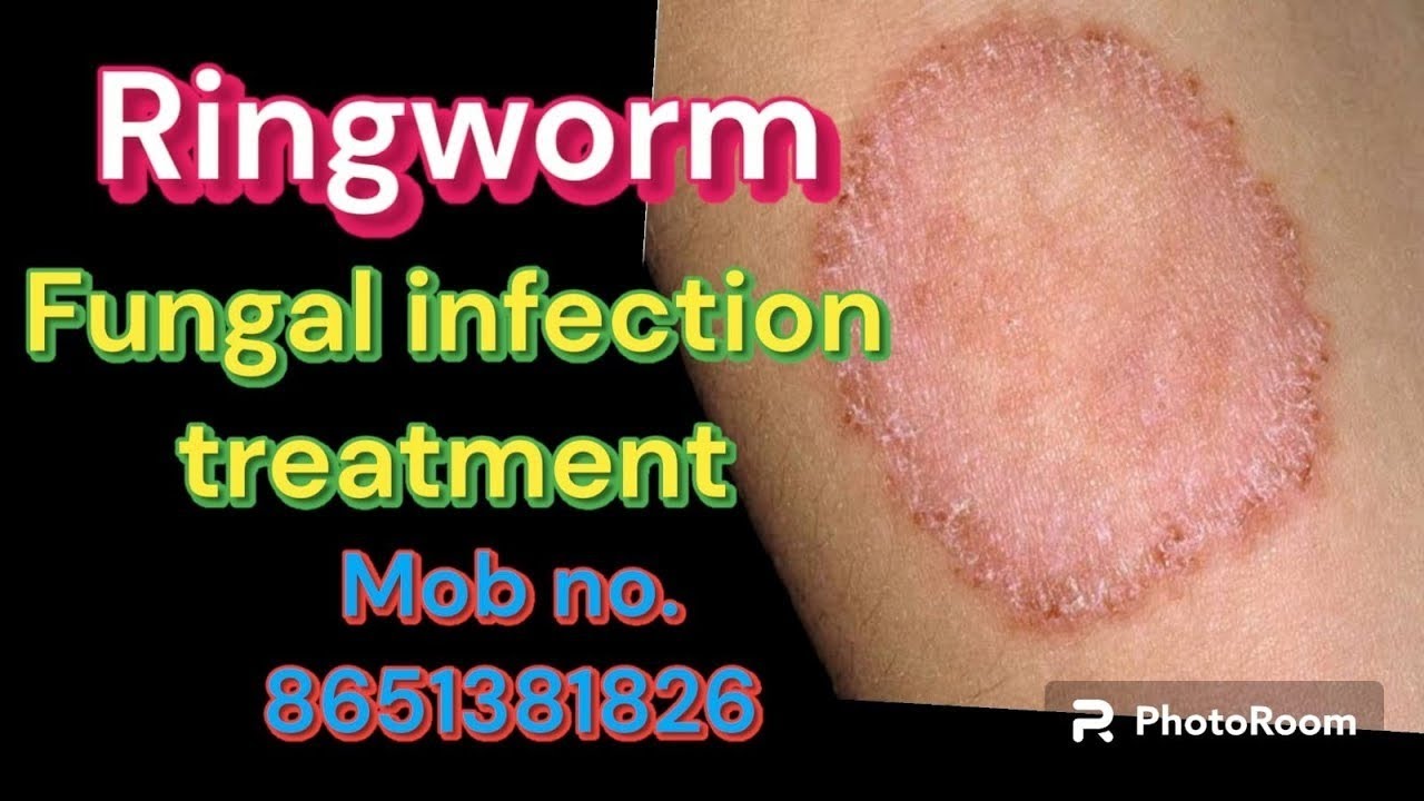 Ringworm homeopathic medicine for ringworm treatment of ringworm 