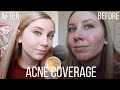 How I cover my acne! | with bare minerals powder foundation!