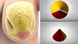 Download 3d Mask And Breast Reduction By Yakup Avsar Md Video MP3 3d Mask And Breast Reduction By Yakup Avsar Md