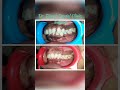 #orthodontictreatment #bracestreatment #teethalignment #smiledesigndental #dentistnagpur #dentist