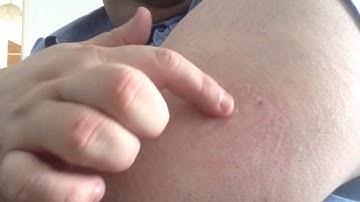 How to remove a FreeStyle Navigator CGM Sensor from your arm