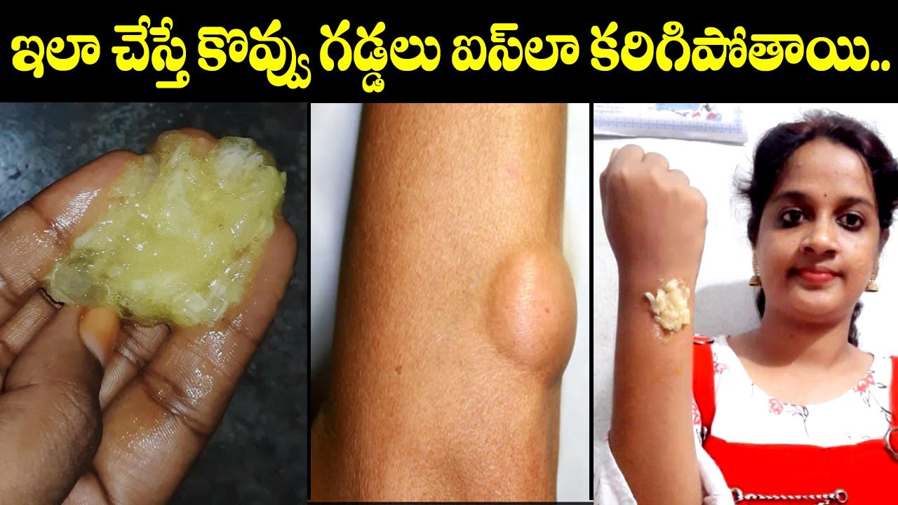కొవ్వు గడ్డలు ఐస్ లా కరగాలంటే Kovvu Gaddalu Karigipovalante Fat