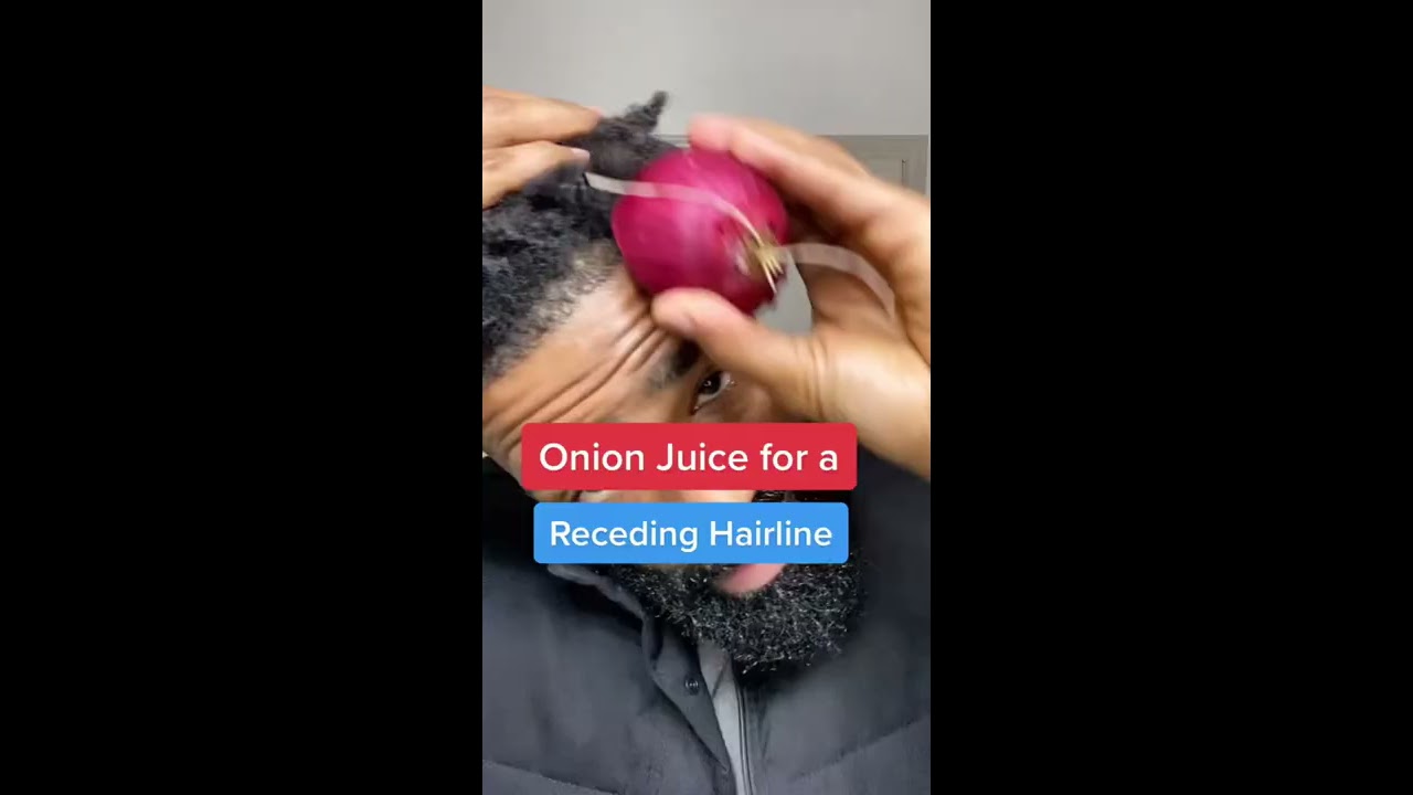 Onion Juice For A Receding Hair Line Shorts