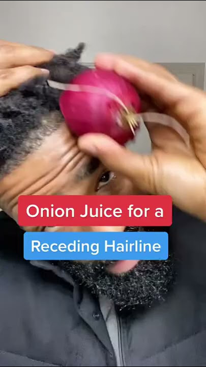 Onion Juice for a Receding Hair Line #shorts